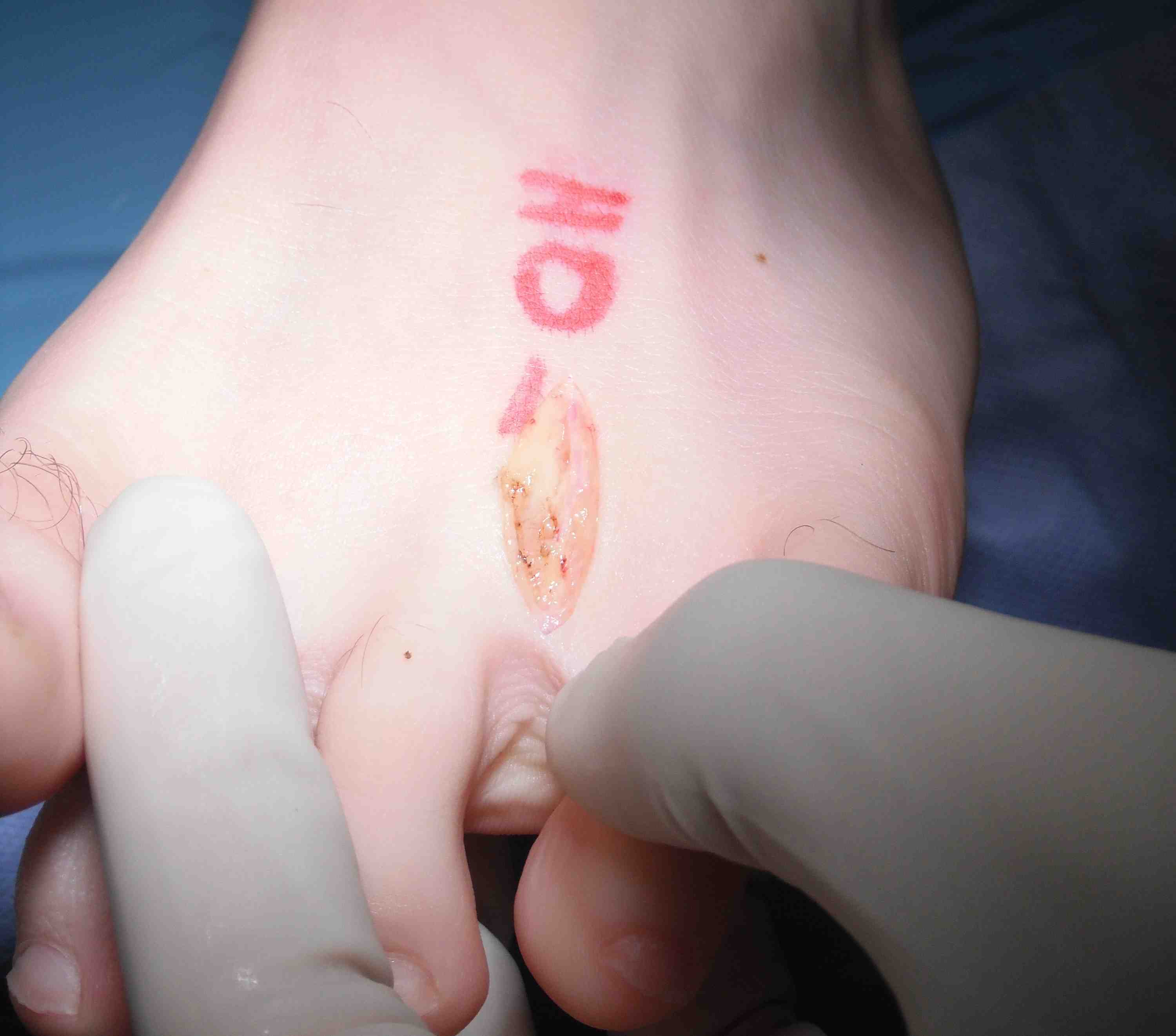 Mortons Neuroma Incision